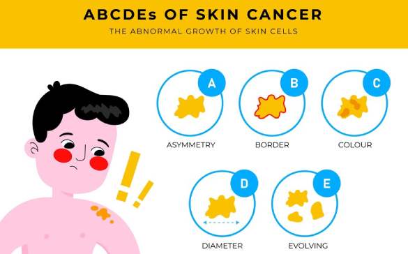 Best skin specialist in Lucknow conducting a skin cancer screening.Skin Cancer Screening by Top Skin Specialist in Lucknow.